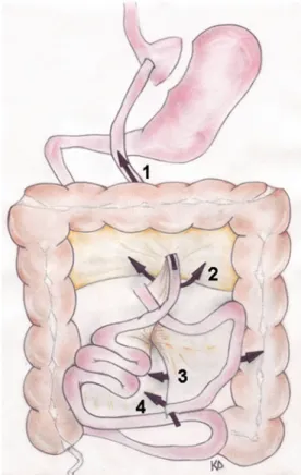 Fig. 2 Schematic drawing localizing the four types of IH occurring after LRYGBP numbered in craniocaudal order according to the position of the hernial orifice