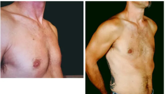 Fig. 2 Forty-five-year-old patient, before (left: depth of PE = 2.5 cm) vacuum bell therapy and after 12 months (right: depth of PE = 0.5 cm)