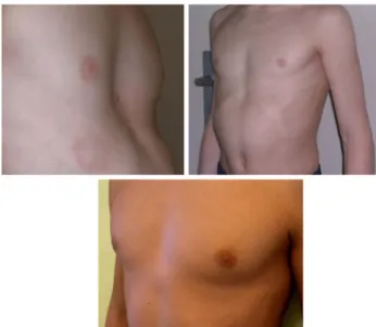Fig. 3 Nine-year-old boy, before (left: depth of PE = 2.8 cm) vacuum bell therapy, after 10 months (right: depth of PE = 1.6 cm) and 36 months after therapy (below)