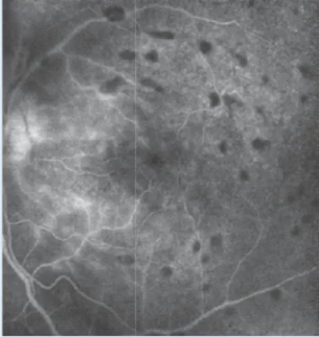 Abb. 1  7  Fundus foto   OS: Arterienastver- schluss temporal supe-rior und unklare „white  dots“ Abb