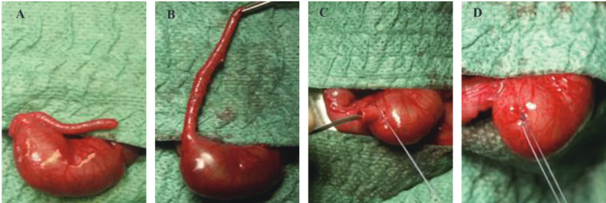 Fig. 1. Steps for the aseptic intussuscepted incidental appendectomy. A: cecum with appendix; B: completely skeletonized appendix; C: appendix  intussusception; D: tied purse-string suture.