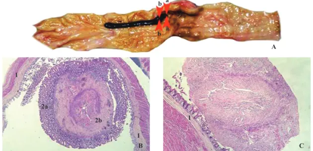 Fig. 2. Autopsy specimen. A: Opened cecum with inverted necrotic appendix and intact cecal wall: histological sections were taken at level a-a at  the border between the inverted appendix and the cecum, and at level b-b some millimeters distally; B: Micros