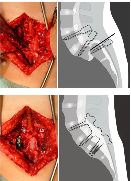Fig. 2 Intraoperative photograph and drawing after the reduction
