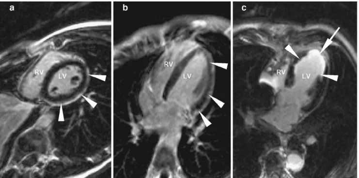 Fig. 1 Late contrast enhanced CMR (3D segmented FLASH sequence with inversion-recovery preparation [TR: 700, TE:1.53, TI: 250, slice thickness 4 mm]) acquired 10 minutes after injection of 0.2 mmol/kg gadolinium in myocarditis (a and b) and in myocardial i