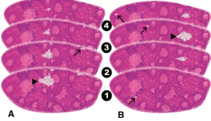 FIG. 2 Two step-sectioned SLN with different tumor localizations.
