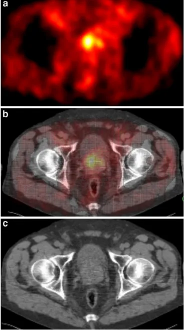 Fig. 1. 11 C-acetate PET of patient 8 performed 30 months post RT.