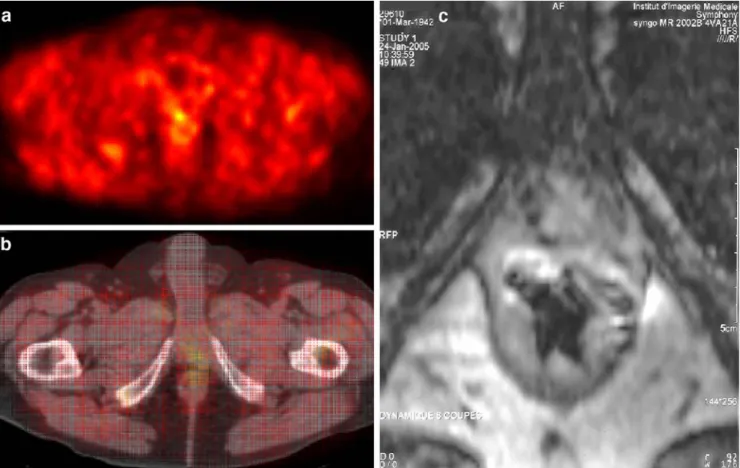Fig. 3. 11 C-acetate PET of patient 23, performed 24 months post surgery. The pre-surgical PSA value of 13.2 ng/ml fell to 0.06 ng/ml before rising again to 0.26 ng/ml at PET