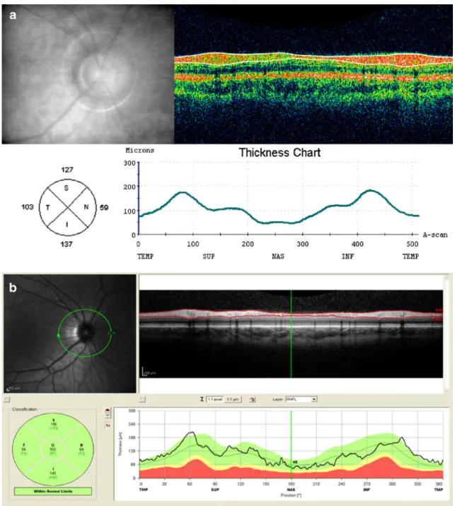 Fig. 1 Retinal nerve fiber layer (RNFL) measurement of a subject of a non-glaucoma group consisting of healthy volunteers with  time-domain (TD) OCT (a) and spectral-time-domain (SD) OCT (b)
