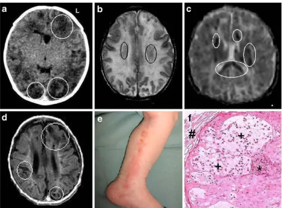 Fig. 1 a Head CT (without contrast, day 3): frontal and occipital patchy low density changes in the cortex and white matter (white circles)