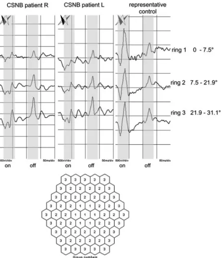 Figure 2. Multifocal ERG on- and off-responses of the CSNB patient (right eye: left column, left eye: middle column) and a repre- repre-sentative control (right column) after stimulus presentation with the LED-monitor.
