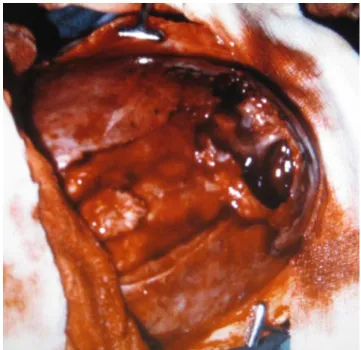 Fig. 4 Operative findings in case 1 at age 2.5 months in whom the sagittal suture (on the left side) and the ossified cephalhematoma (on the right side) have been removed step by step