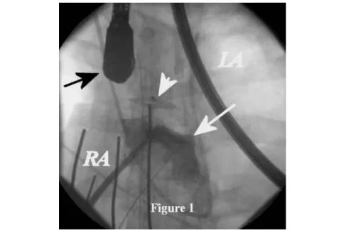 Fig. 1 Fluoroscopy image showing contrast medium (c.m. white arrow) injection in  the right atrium (RA) without passage of c.m