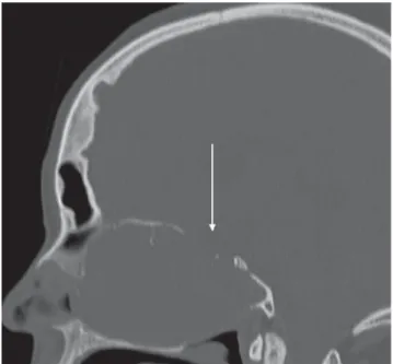 Figure 1a. Sagittal re-formatted bone windows CT image demon- demon-strates erosion of the frontobasis (arrow)