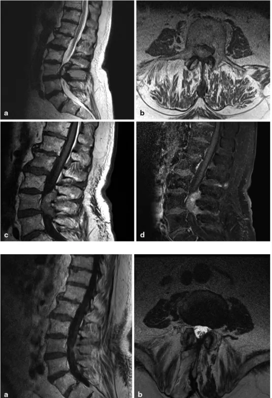 Fig. 2  Follow-up after 4  weeks. a Midsagittal  T2-weighted MrI showing the  extension of the epidural  lesion at L3 with hyper- and  hypointense components