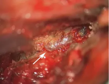 Fig. 4 Intraoperative image showing the bluish appearing encapsu- encapsu-lated lesion, strongly adherent to the ligamentum flavum