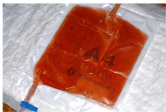 Fig. 1 The patient ’ s red urine during the acute attack