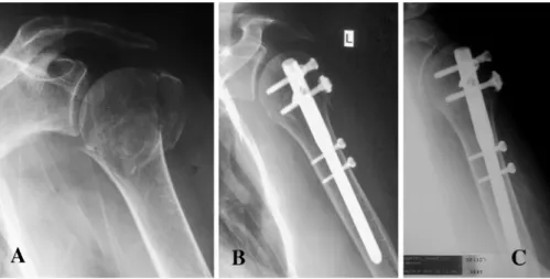 Fig. 2 Radiographic sequence  of a two-part humeral head  frac-ture. a Conventional X-ray of  the shoulder after suVering the  accident