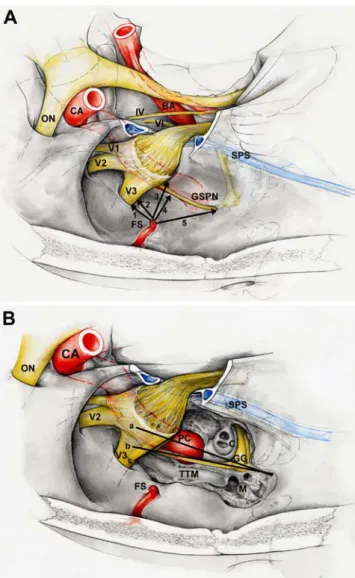 Fig. 1 Schematic illustration of Fig. 2 showing the measured distances and angles. A Distance measured from the foramen spinosum to: (1) the foramen ovale; (2) the mandibular branch of the trigeminal nerve (V3); (3) the middle of the petrous carotid artery