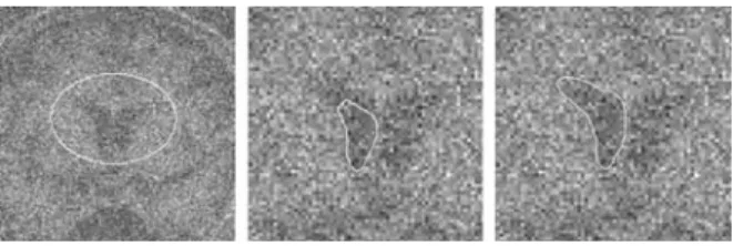 Figure 21. Evolution of the active contour (in solid line) with a shape prior (in dotted line) in the presence of an important quantity of noise.