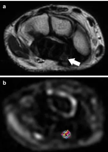 Fig. 1 a Transaxial T2-weighted fast spin-echo sequence (TR/TE, 3500/87 ms; echo train length, 11) of the left wrist at the level of the flexor retinaculum in a 28-year-old healthy female volunteer acquired as anatomic reference image to identify the media