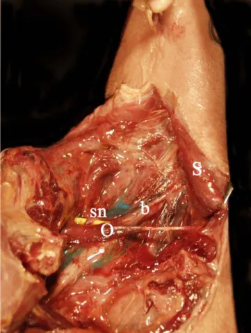 Fig. 2 Right lateral cervical region s sternocleidomastoid muscle: