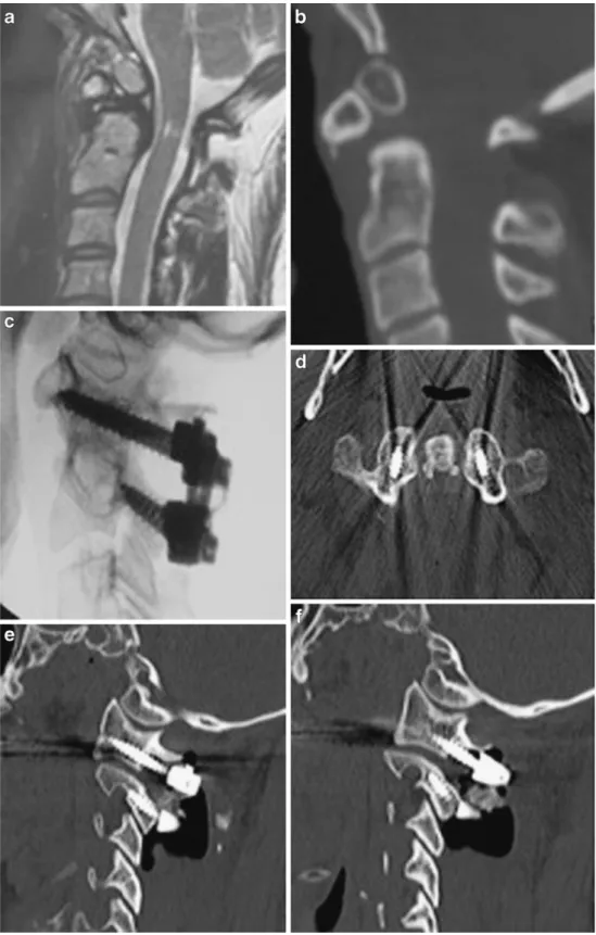 Fig. 1 Os odontoideum. a MR image showing an os  odontoi-deum with a high cervical spinal cord hypersignal
