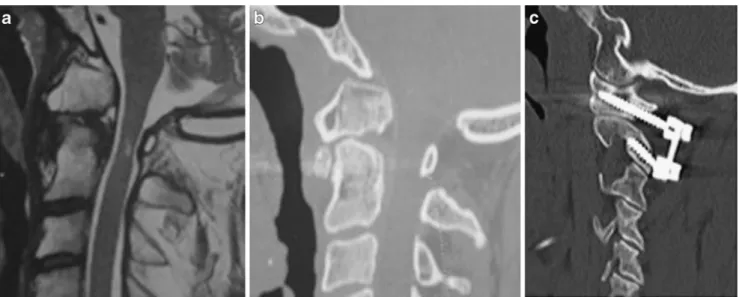 Fig. 2 Old non-healed type II odontoid fracture. a MR image showing an old non-healed type II odontoid fracture with fusion between the anterior C1 arch and the bony fragment