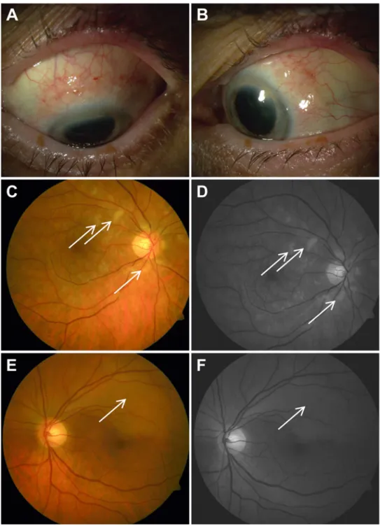 Fig. 1 Nodular conjunctivitis of the left eye without associating episcleritis/scleritis (a, b)