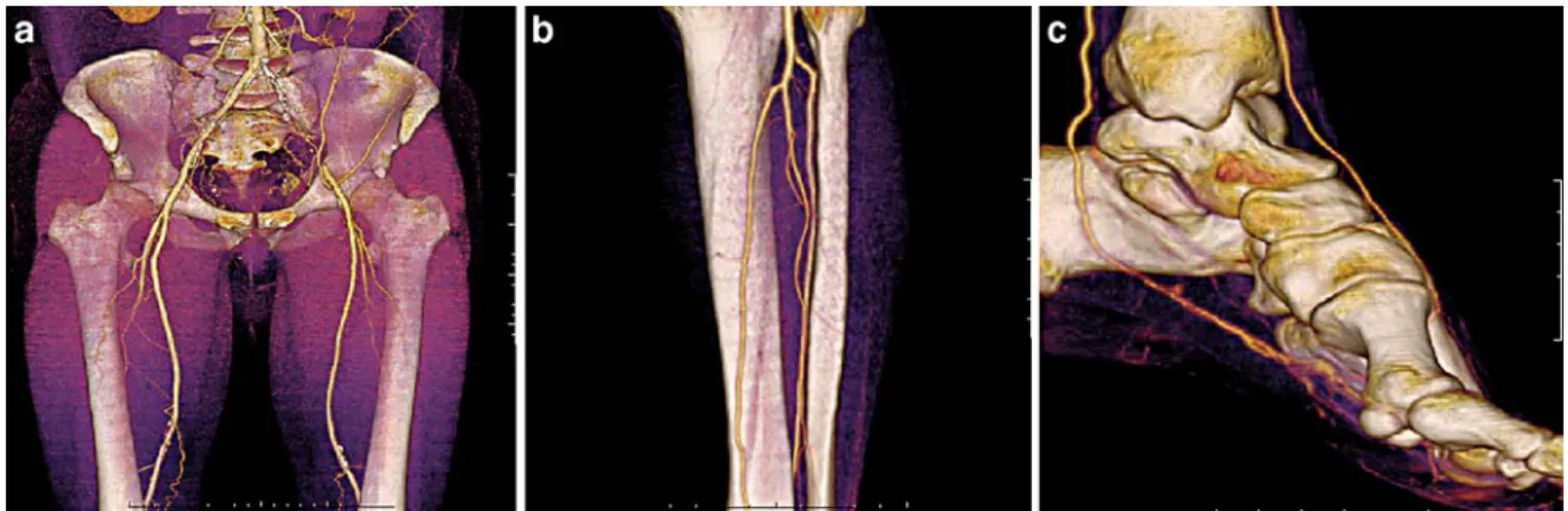 Fig. 4 a–c An 80-year-old man with grade IV left lower limb ische- ische-mia with aorto-bifemoral bypass and occluded bilateral  femoropop-liteal bypass