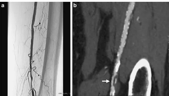 Fig. 5 a, b A 63-year-old woman with intermittent  claudi-cation of the left lower limb