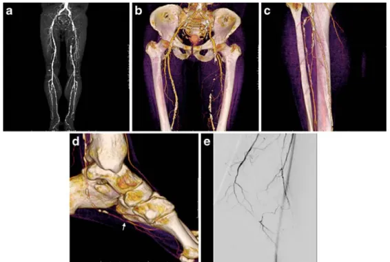 Fig. 7 a–e A 63-year-old man smoker, hypertensive and hyper- hyper-cholesterolemic presented with a progressing left-side calf  claudi-cation (walking distance less than 100 m)