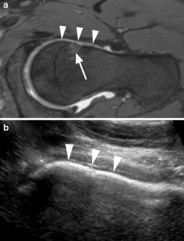 Fig. 4 A 40-year-old man with considerable waist de ﬁ ciency consistent with cam impingement ( arrowheads )