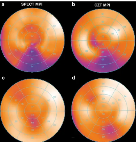 Fig. 2 SPECT MPI image without AC (a) and CZT MPI image without breath-hold triggering (b) show an apparent inferior perfusion defect which was identified as an artefact as it is not present on the SPECT MPI image after AC (c) or on the CZT MPI image after