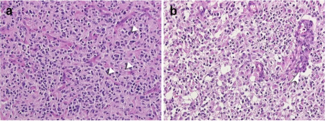 Fig. 1 Examples of histology in two tumors diagnosed as glioblas- glioblas-toma with oligodendroglioma-like component