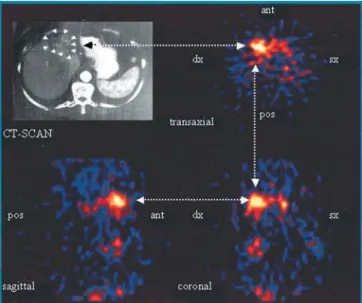 Fig. 2. SPECT images obtained 21 h after injection of radioiodi- radioiodi-nated scFv(L19), showing the transaxial, sagittal and coronal  pro-jections of the abdomen of a patient with liver metastases of  colo-rectal cancer, were matched to the CT scan of 