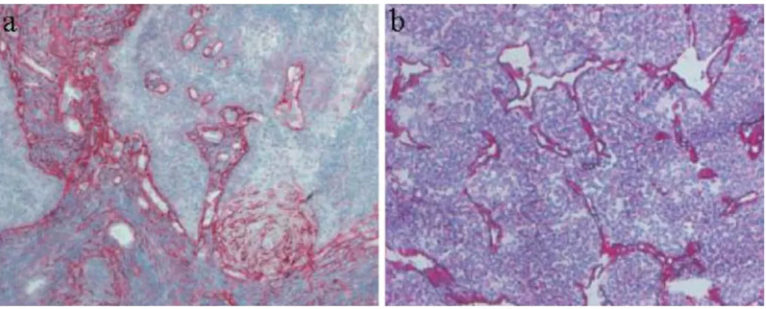 Figure 3 shows tumour sections stained with the L19 antibody specific to EDB and with a human monoclonal antibody specific to a large isoform of tenascin-C