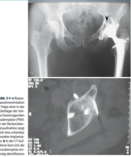 Abb. 3  7  a Iliopso-  a Iliopso-assehnenirritation  als Folge einer in das   Gleitlager der Seh-ne hineinragenden  Schraubenspitze (Pfeil).   In der Beckenüber-sichtsaufnahme zeigt  sich eine scheinbar   korrekte Implantat- lage. b In der CT-Auf-nahme läs