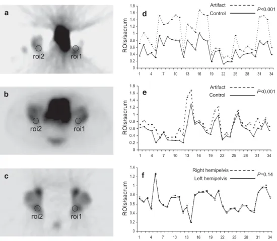 Fig. 1  Transaxial single  photon emission computed  tomography (SPECT) of the  pelvis displays characteristic  streak and count loss artifacts  caused by a full bladder after  fi ltered backprojection (a),  and substantial amelioration  after iterative re