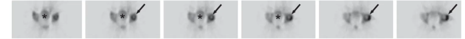 Fig. 2  Transaxial SPECT of the pelvis in a 48-year-old male  patient shows residual urinary activity (asterisks) after his bladder  had been emptied twice