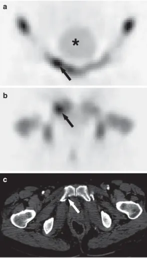 Fig. 4  Coronal (a), and transaxial (b) SPECT of the pelvis in a  57-year-old female patient after a traffi c accident display a hot spot  in the right superior pubic ramus (arrows) suggesting a  frac-ture that was confi rmed by CT (c)