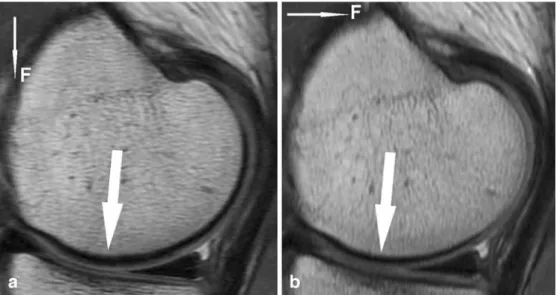 Fig. 3 Sagittal intermediate- intermediate-weighted FSE MR images of the knee in a 24-year-old volunteer obtained at 3.0 T using the following imaging parameters: