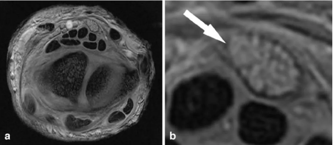 Fig. 7 Coronal fat-suppressed intermediate-weighted FSE MR images from a 37-year-old patient at 3.0 T in a measuring time of 1 min and 25 s using a four-channel knee coil