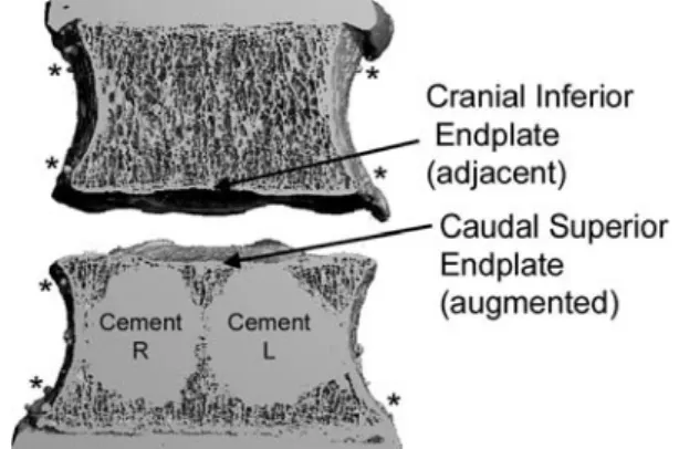 Fig. 1 Sagittal slice through an augmented FSU. Augmentation was performed bilaterally