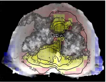 Fig. 10 The endplate was free to deform in regions in which the cement was not directly beneath the endplate