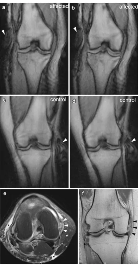 Fig. 5 Dynamic and morphological MRI in a 40-year-old woman. Physical examination revealed a grade 2 medial collateral ligament (MCL) injury of the right knee, whereas MR images depicted a complete rupture of the MCL (grade III)