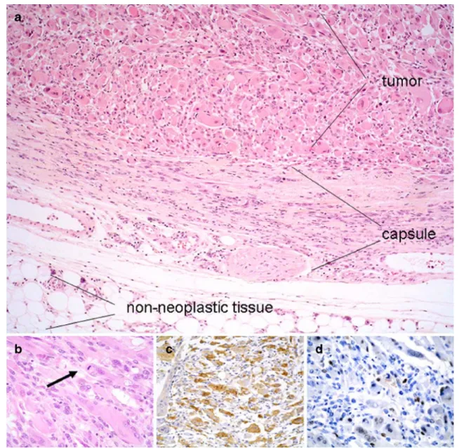 Fig. 1 Examples of a biomaterial-induced sarcoma (pleomorphic rhabdomyosarcoma from animal 46 PU 101)
