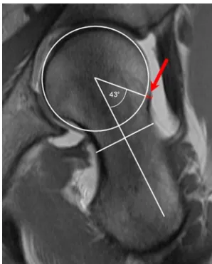 Fig. 5 Schematic of the proximal femur showing the clockwise rotation of the MRI slices, in which measurements were taken.