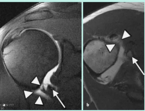 Abb. 10  8   Ad hä si ve  Kap su li tis, a  T1-ge wich te te  pa ra sa git ta le, b  T2-ge wich te te  pa ra ko ro na le  fett sa tu rier te  MR-Ar thro gra phie-Auf nah me, a  Ver di ckung  der  Ge lenk kap sel  (Pfeil spit zen)  (di cker  als  6  mm)  au