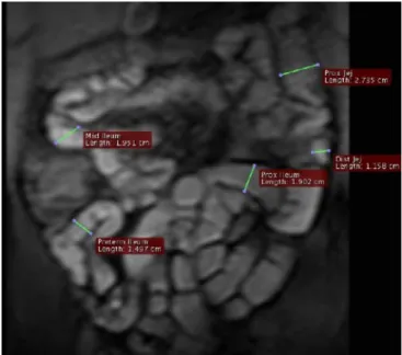 Fig. 3 Coronal slice of a 2D T1-w GRE sequence for the detection of small bowel motility after administration of 1,200 ml water spiked with 0.2 g/kg BW ispaghula and 20 ml Gd-DOTA