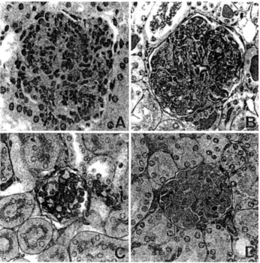 Fig.  2.  A  Representative histological appearance of glomerular  lesions in  mice sacrificed 5  days  after the  injection  with  6-19  hybridoma  cells9  Note  the  infiltration  of  PMN  and  increased  glomerular  cellularity